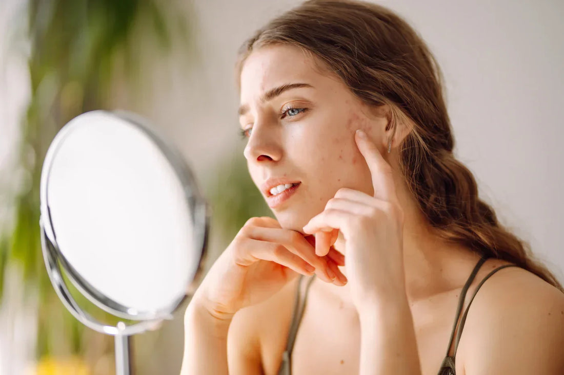 Akne – was tun, wenn die Haut Alarm schlägt?